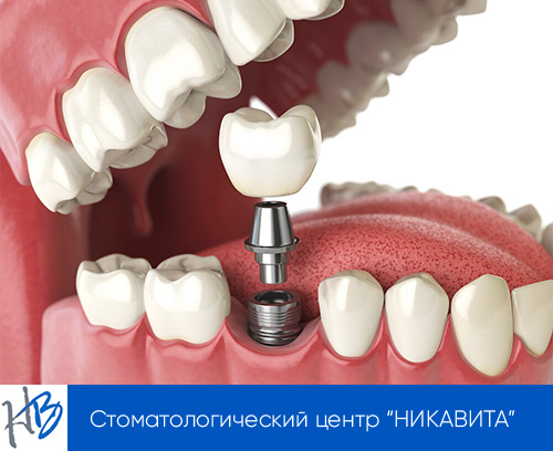 установка импланта на зуб
