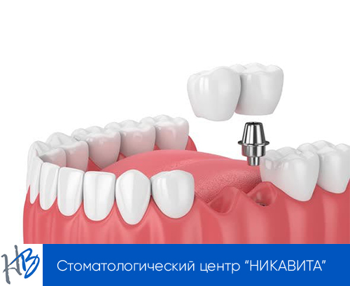 установка имплантов на два зуба