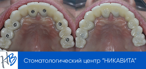 примеры имплантации зубов