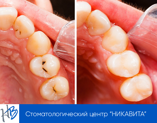 до/после лечения кариеса зубов