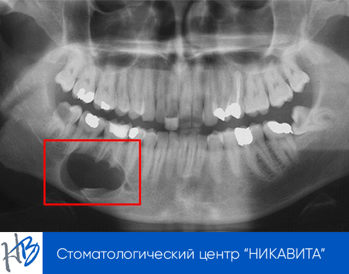 Киста зуба | симптомы, диагностика, лечение, профилактика