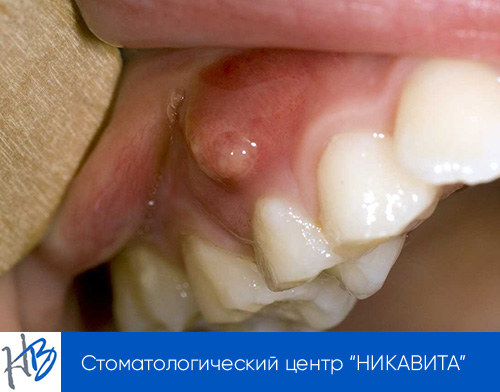 киста зуба лечение