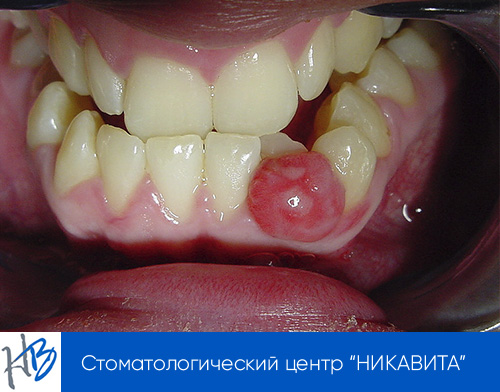 осложнения кисты зуба