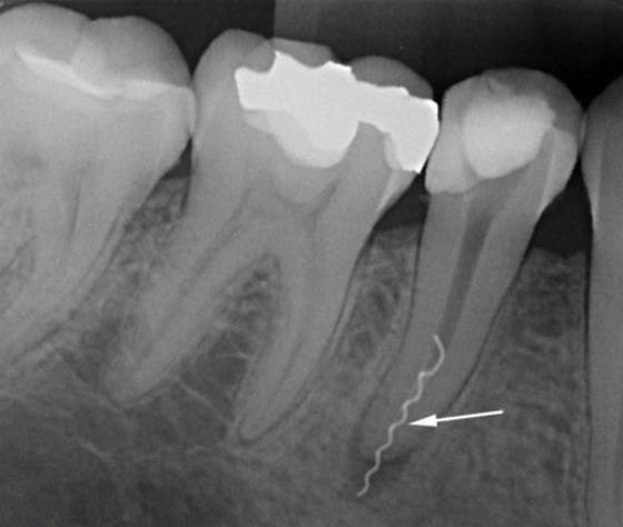 Болит зуб после пломбирования каналов - Что делать и куда обращаться?