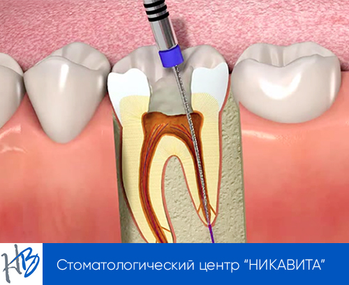 Вопросы об удалении нерва в зубе