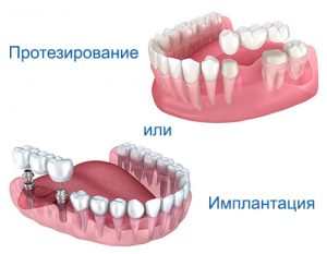 протезирование или имплантация: что выбрать