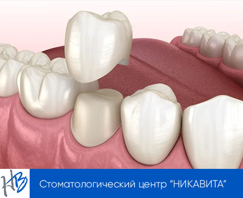 установки коронки на сохраненный корень зуба